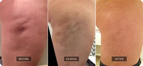 6 Myths About FasciaBlaster Damage & Bruising .